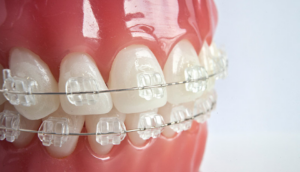 Сапфірові брекети: нова тенденція у стоматології